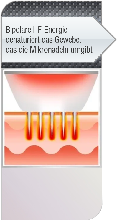 Bipolare HF-Energie ist direkt auf die Zielgebiete angewendet