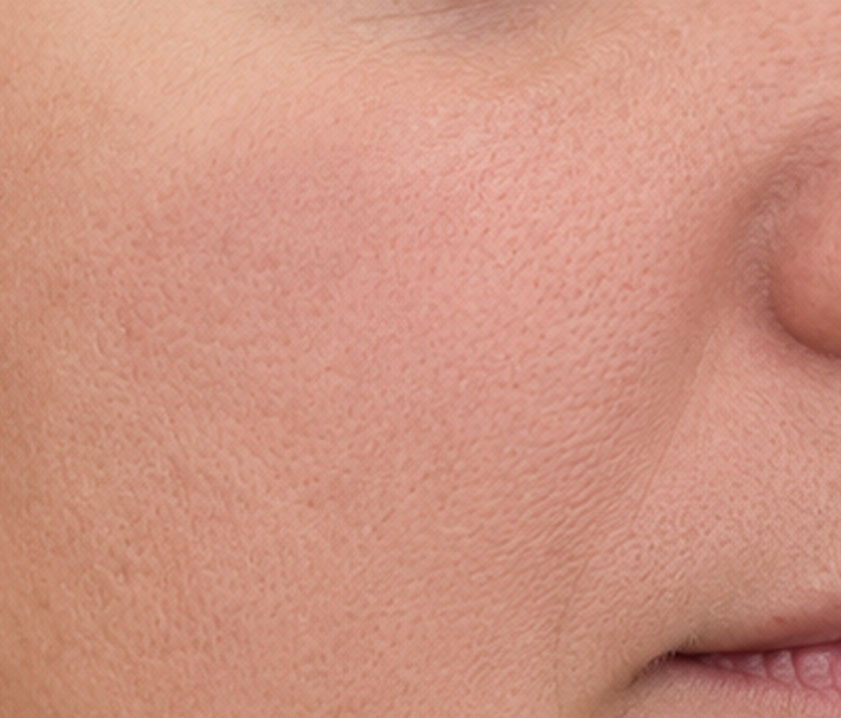 Vorher Nachher Ergebnis bei Visage Cosmetic Vorher
